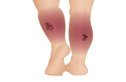 DVT (Deep Vein Thrombosis) Treatment In India : Cost, Hospitals & Doctor